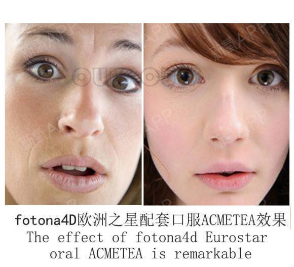 治疗欧洲之星fotona4d做一次有效果吗？为了挽回我的青春加油