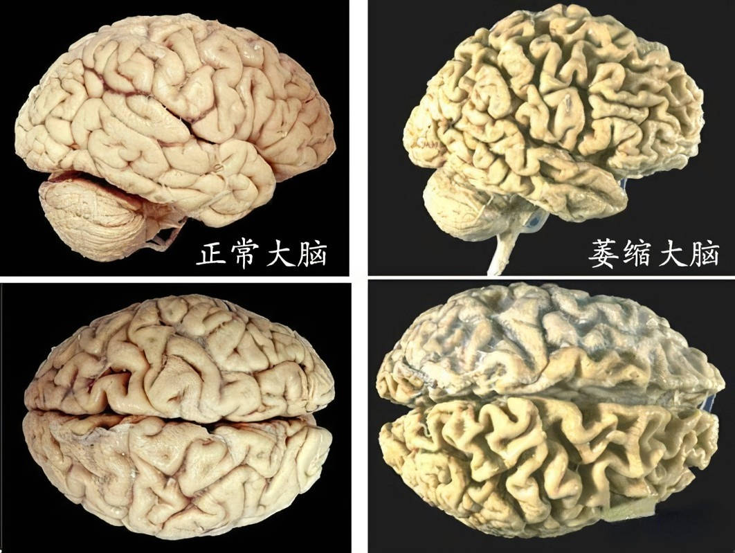 因饮酒导致的脑灰质和白质体积变化,与衰老所导致的变化相似,本研究