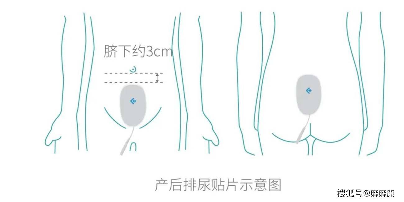 原创如何防治产后尿潴留记住这5个小妙招