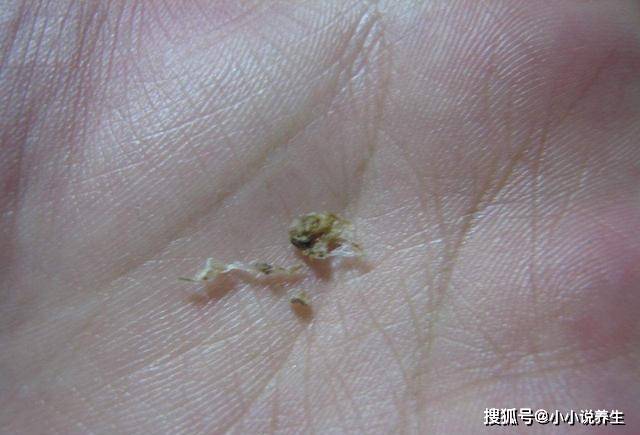 为什么有的人耳屎很干,有的人耳屎却很湿,二者对健康有影响吗_内耳