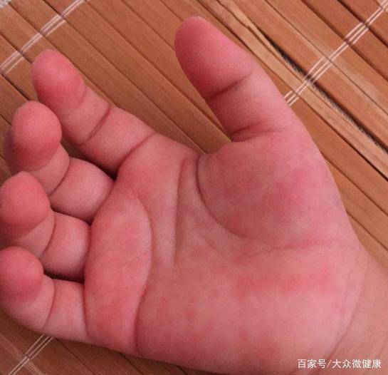 肝掌通常是在手掌大拇指和小指的根部的大小鱼际处皮肤出现片状充血