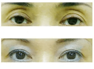 什么嗨体熊猫针是什么？一篇干货满满的「黑眼圈医美」分享