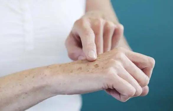 进行为啥有些老人的老年斑“密密麻麻”,有的人却没有?让医生告诉你