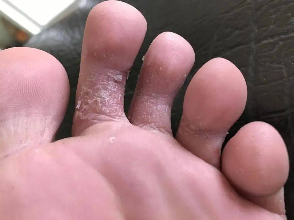 武汉太医堂中医院告诉您如何去除脚臭?_细菌_鞋子_脚底