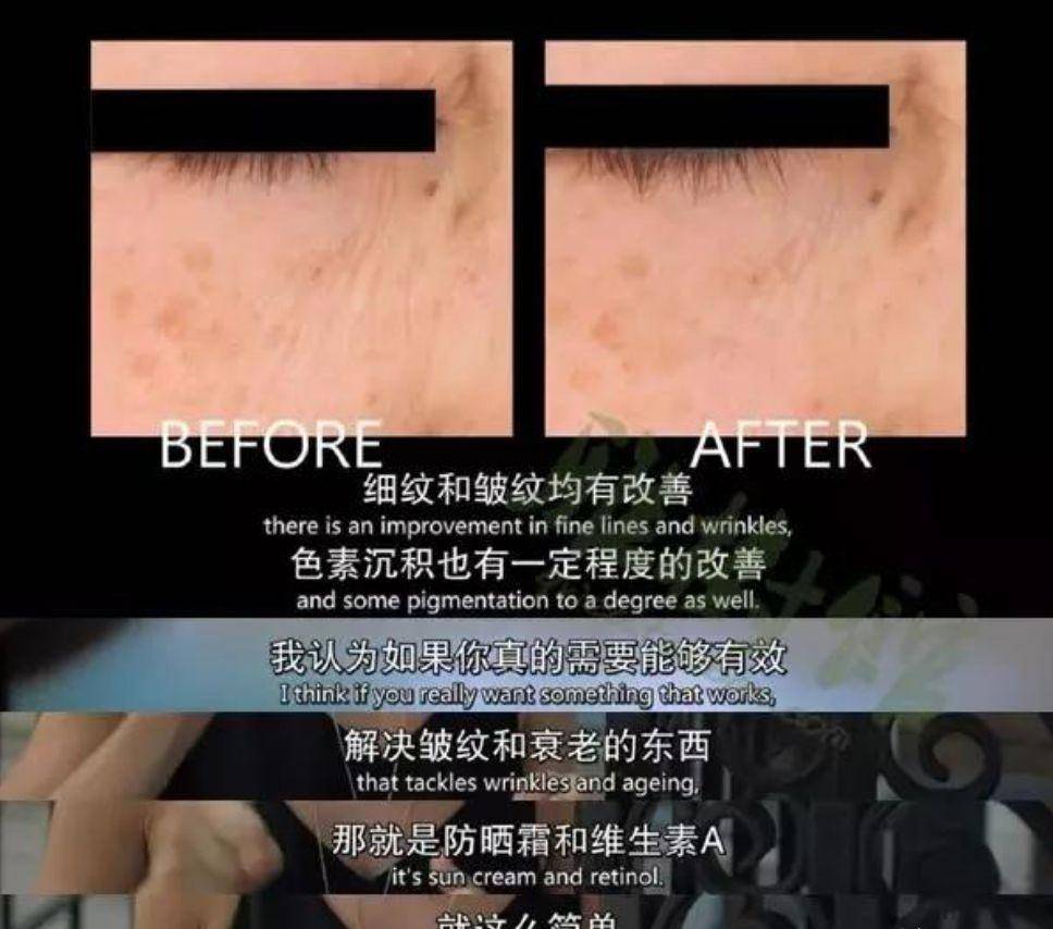 什么刘诗诗产后是做了什么项目吗？眼睛居然比22岁的朴彩英还显年轻