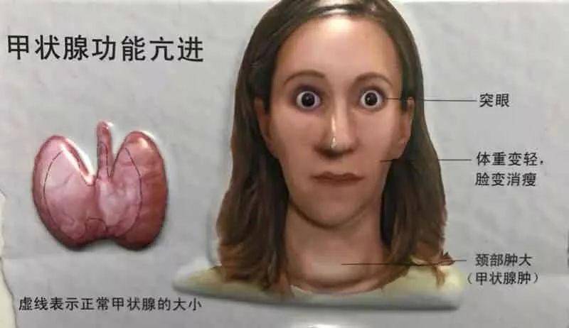 甲亢如果没有得到及时的诊断和治疗,会影响人的工作和生活,严重者会