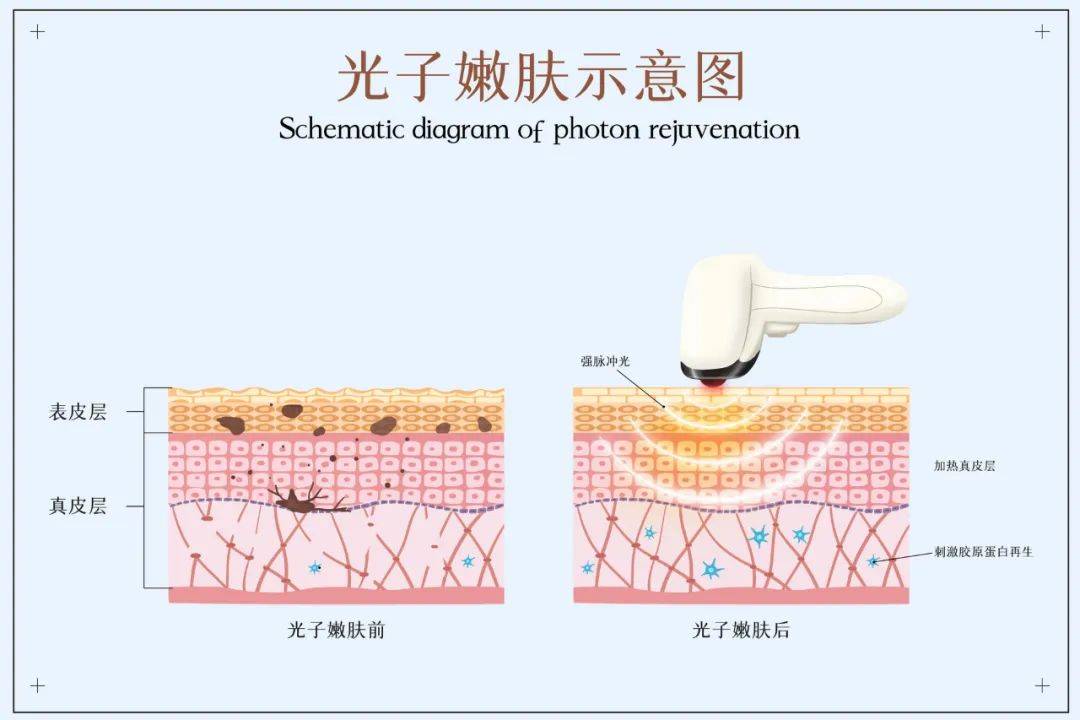 知识科普医美科普 | 不同的皮肤类型怎么选择水光？