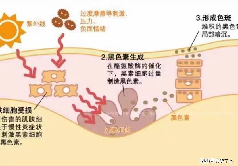 激光【关于如何淡斑】我这儿给大家几个实在建议