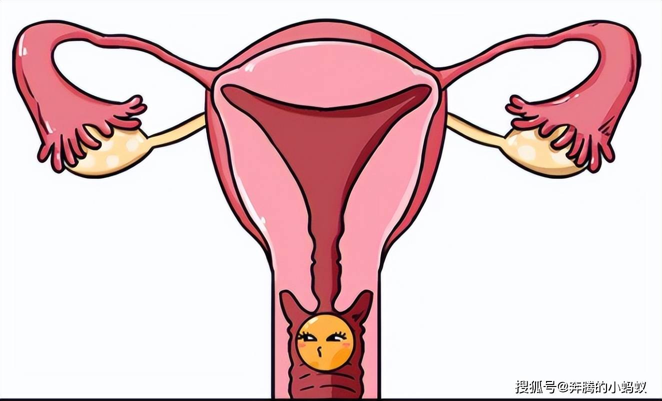 1,肿物脱出:未婚的患者因发现宫颈息肉较晚,多表现为阴道口有肿物脱出