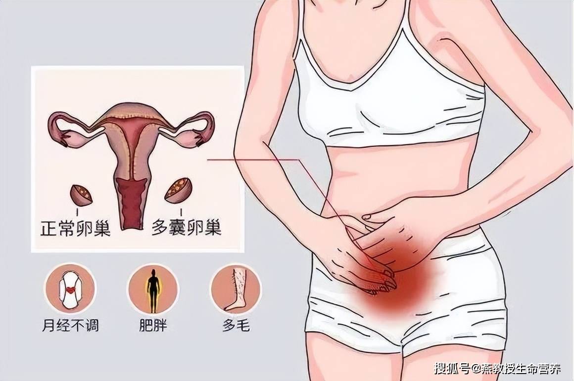 3)卵巢多囊性改变三项症状中的两项就可以被诊断为pcos.