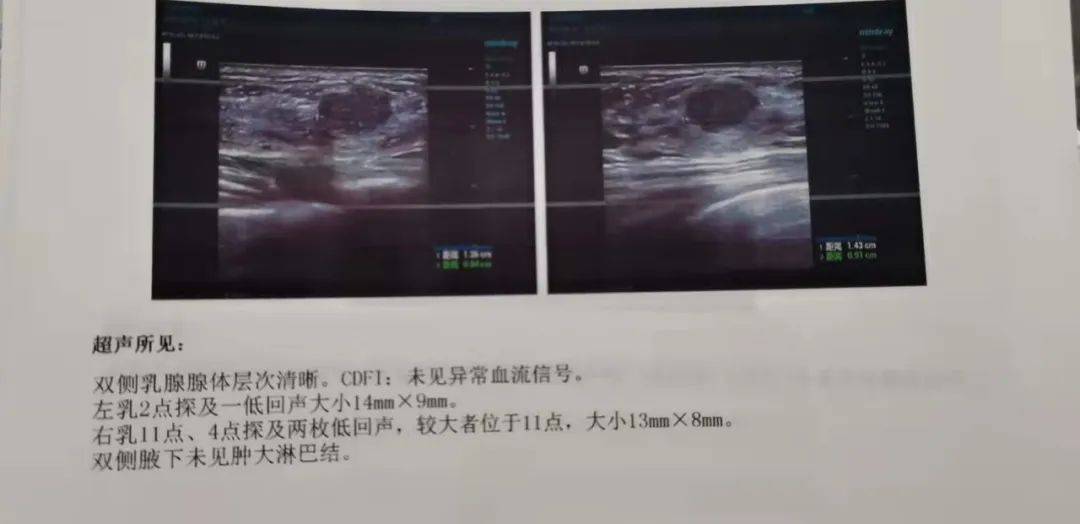乳腺检查报告单图片图片