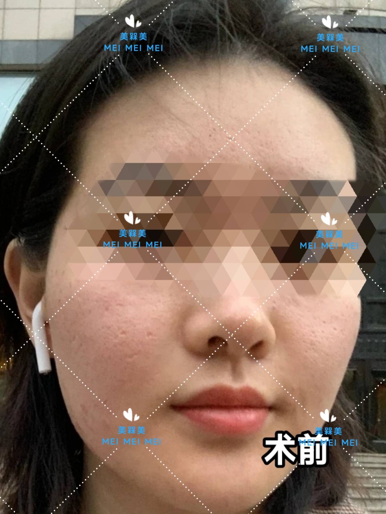 差不多【美人汇】痘痘肌少女的逆袭之路