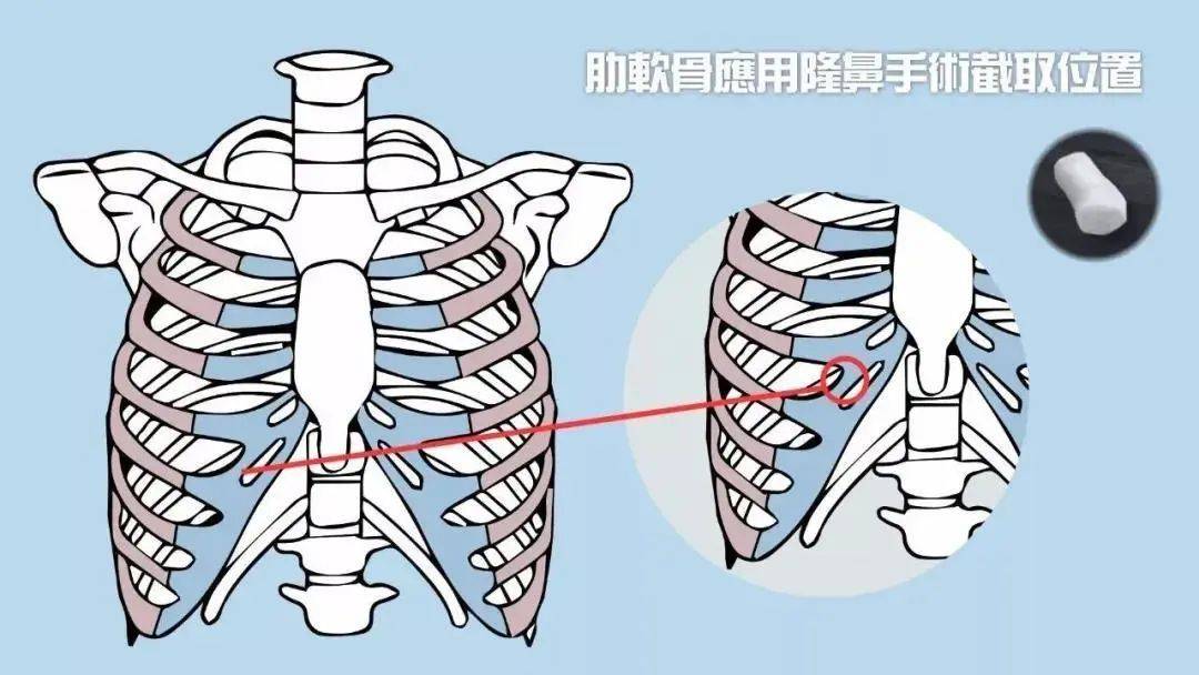 变形关于隆鼻选择那种材料比较好