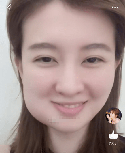 明星拔智齿脸肿周冬雨笑哭乔欣可爱看到刘宪华智齿界名人