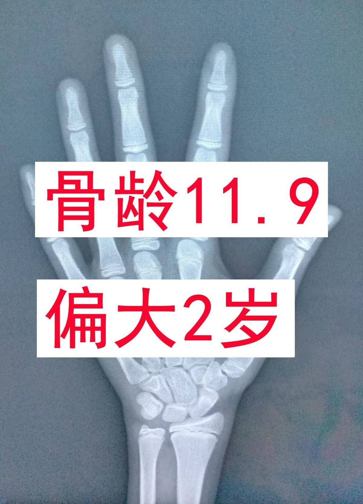 原创孩子后才关注身高长不高的案例太多了家长要注意这3点