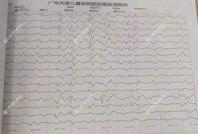 脑电图报告单图片
