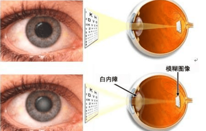如果是因白内障膨胀,过熟导致的青光眼,也就是所谓的晶体源性青光眼