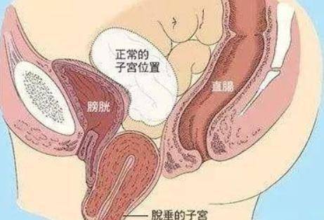 【子宫下垂】子宫下垂的原因_子宫下垂的危害_子宫下垂的预防