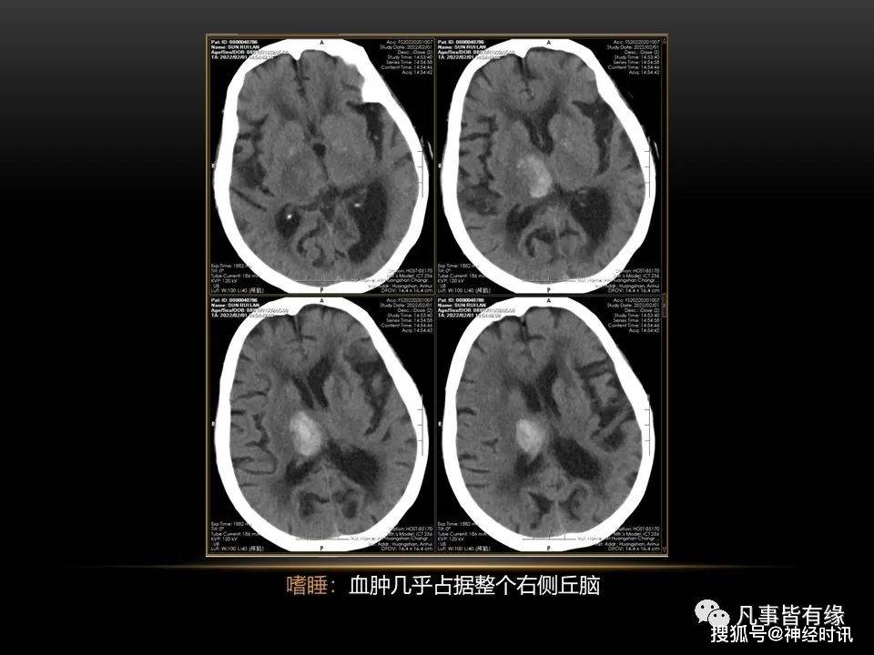 不同部位脑出血截然不同的预后分享交流
