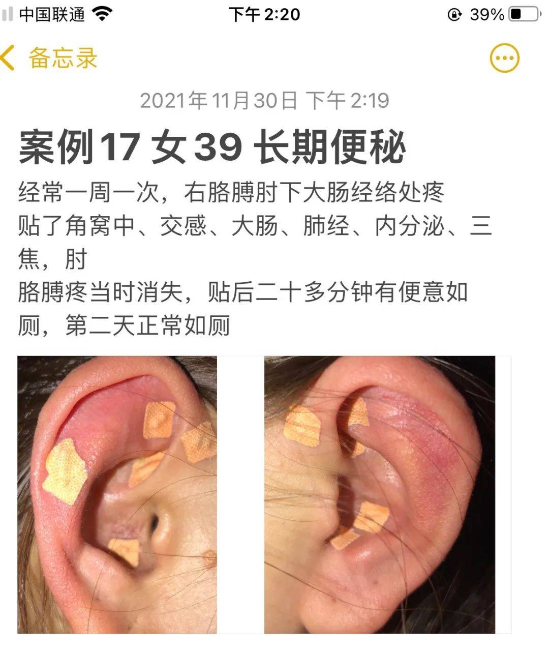 益康耳穴:为什么便秘反反复复困扰你?这个方法你尝试了吗?