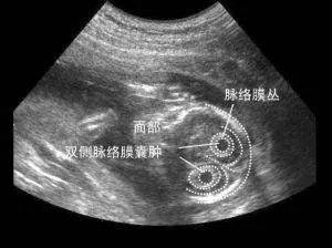 怀孕14周b超男孩图片图片