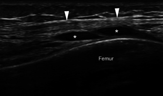 髂胫束综合症超声图像