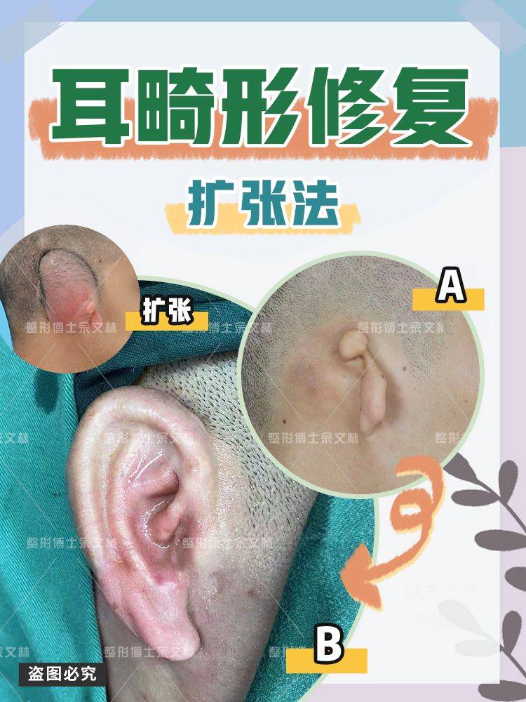 生活中还会有像卷曲耳,隐耳,耳垂裂,附耳(副耳),招风耳,杯状耳,菜花耳