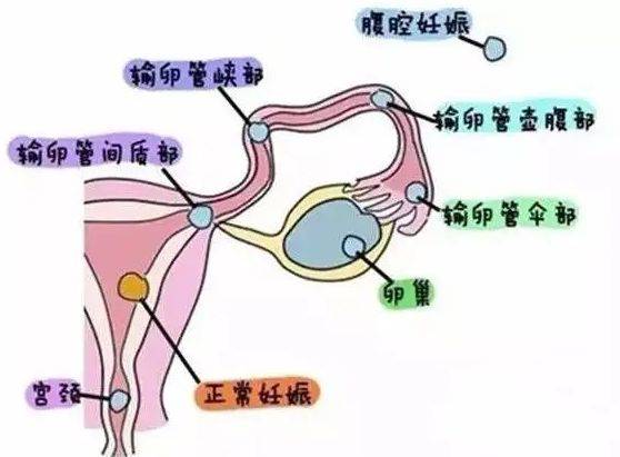 青岛滨海学院附属医院专家说关注异位妊娠67关爱女性健康
