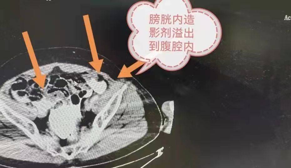 原创男子大量饮酒后为啥膀胱就破了