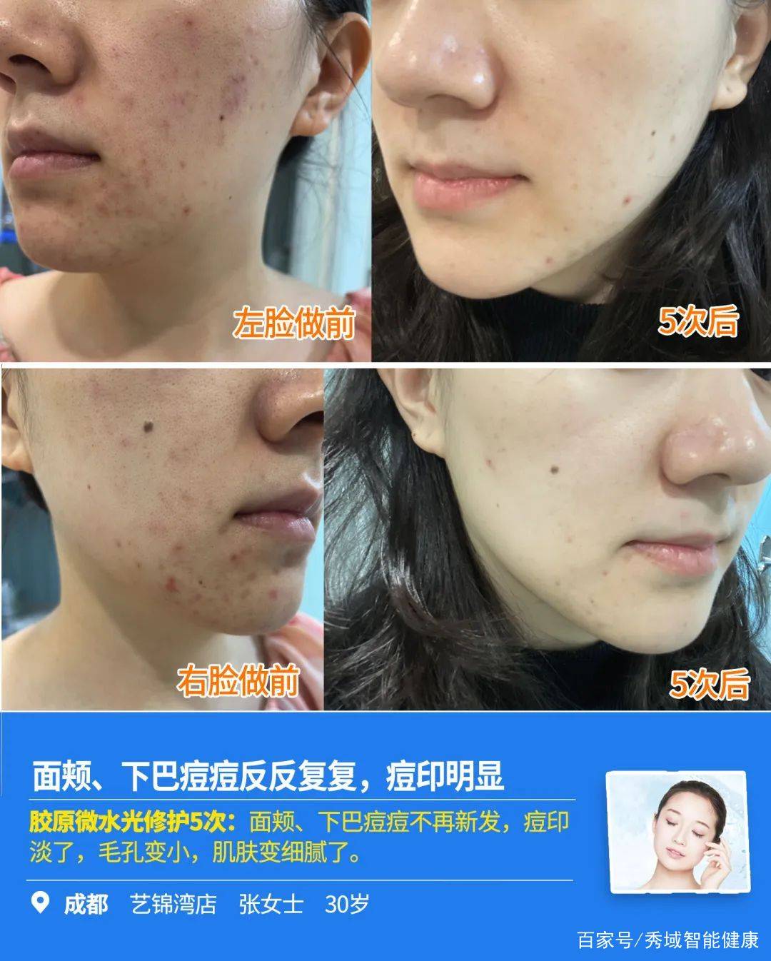 让肌肤焕然一新基因科技物理材料科技生物科技强强联合拯救痘痘肌