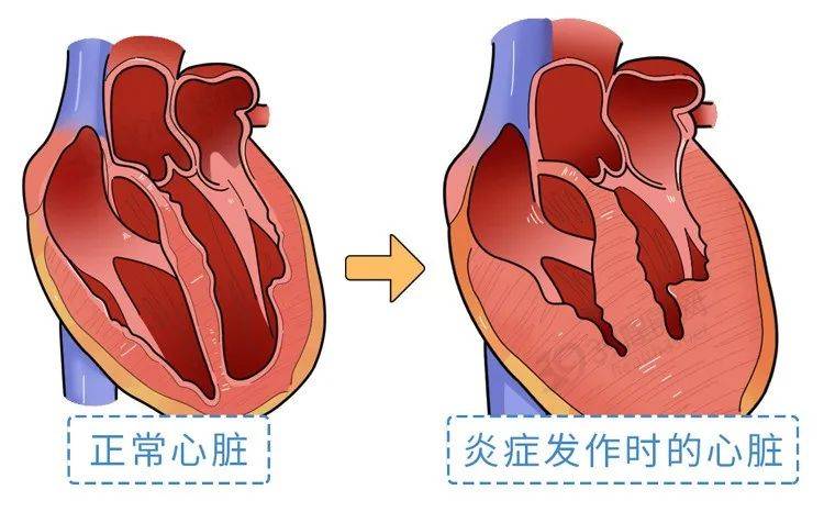 提醒:心肌炎不重视,后果很严重!