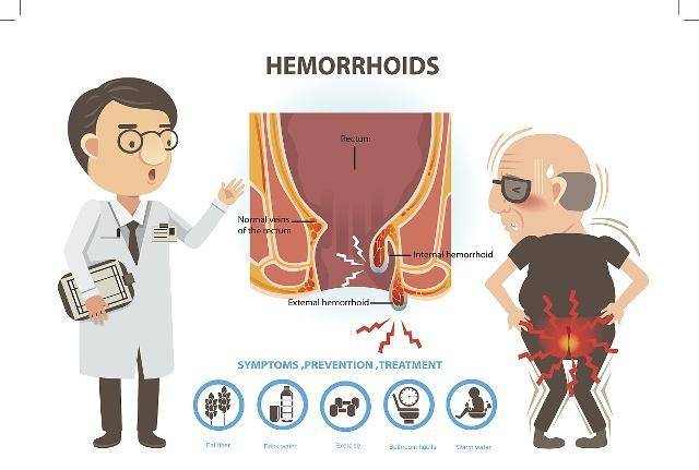 原創做了痔瘡手術後這3個注意事項還得謹記可別不以為然