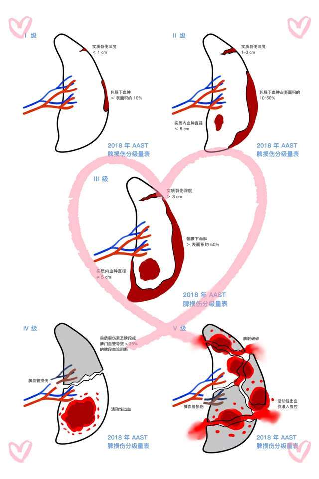 胡金秋脾破裂手术医生告诉你什么是脾破裂严不严重