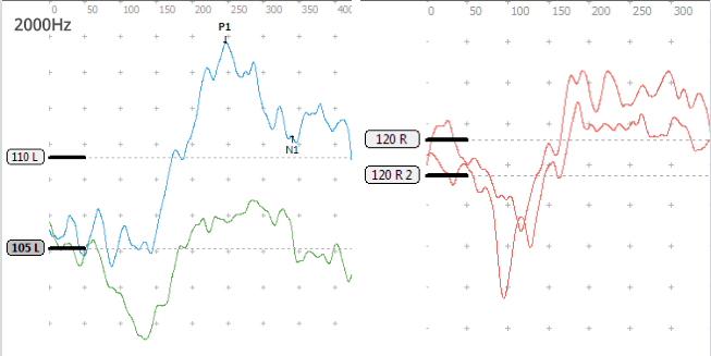图为a型声导抗鼓室02双侧极重度感音神经性听力损失右耳平均听力>106