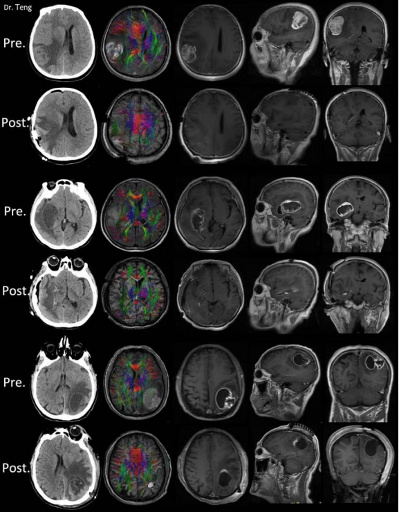 ct筛查发现大脑内左侧顶叶功能区肿瘤.