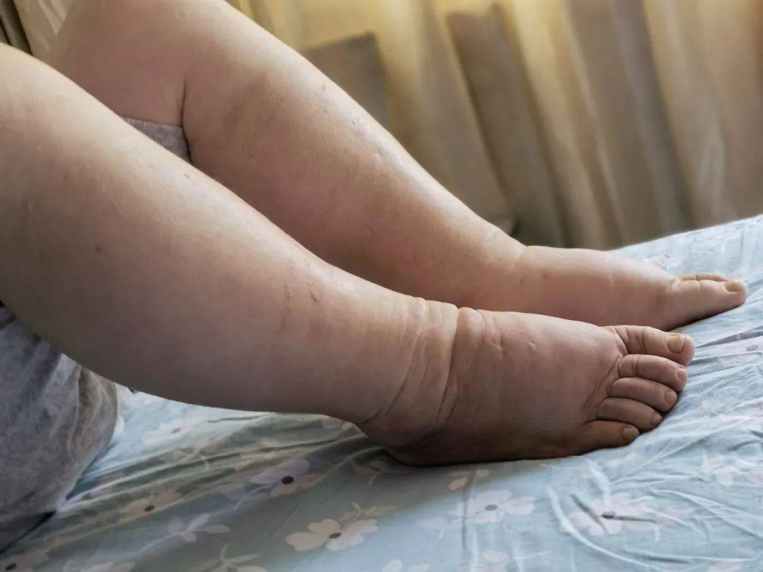 轻者积聚在组织疏松部位,如眼睑和面部,重者全身水肿或伴有胸水腹水