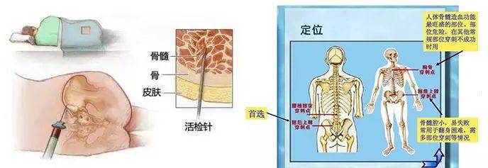 骨髓穿刺位置图解图片