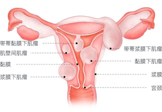 子宫腺肌症B超图片