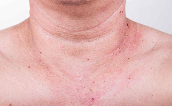 原创皮肤出现这3种怪象不能拖或是糖尿病的敲门声