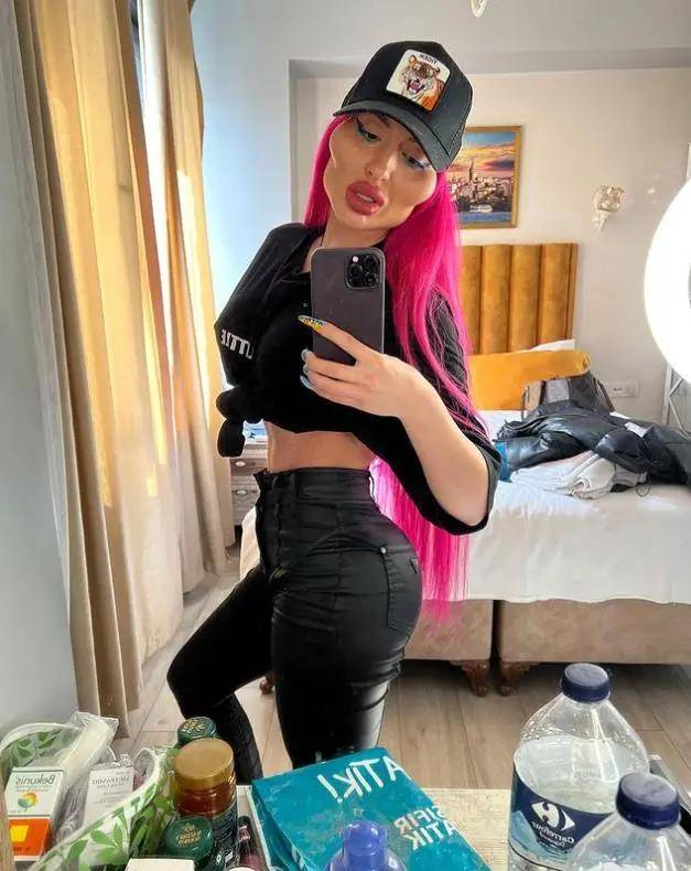 乌克兰模特有了全世界最大颧骨还不满足她把颧骨打得更大了