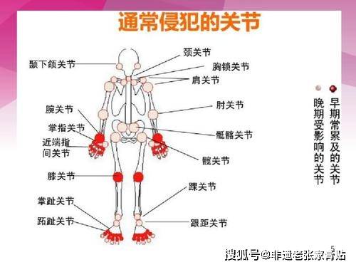 非遗老张家膏贴：各种常见关节炎症状，对照下你属于哪一种