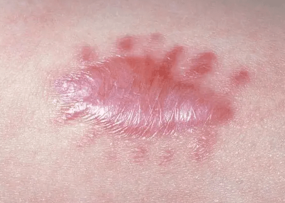 术后疤痕增生是因为医生技术还是个人原因?_进行_皮肤_处理