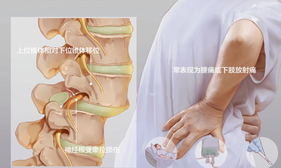 养世纪:中老年朋友腰椎滑脱,怎么预防?一定要做好这4点!