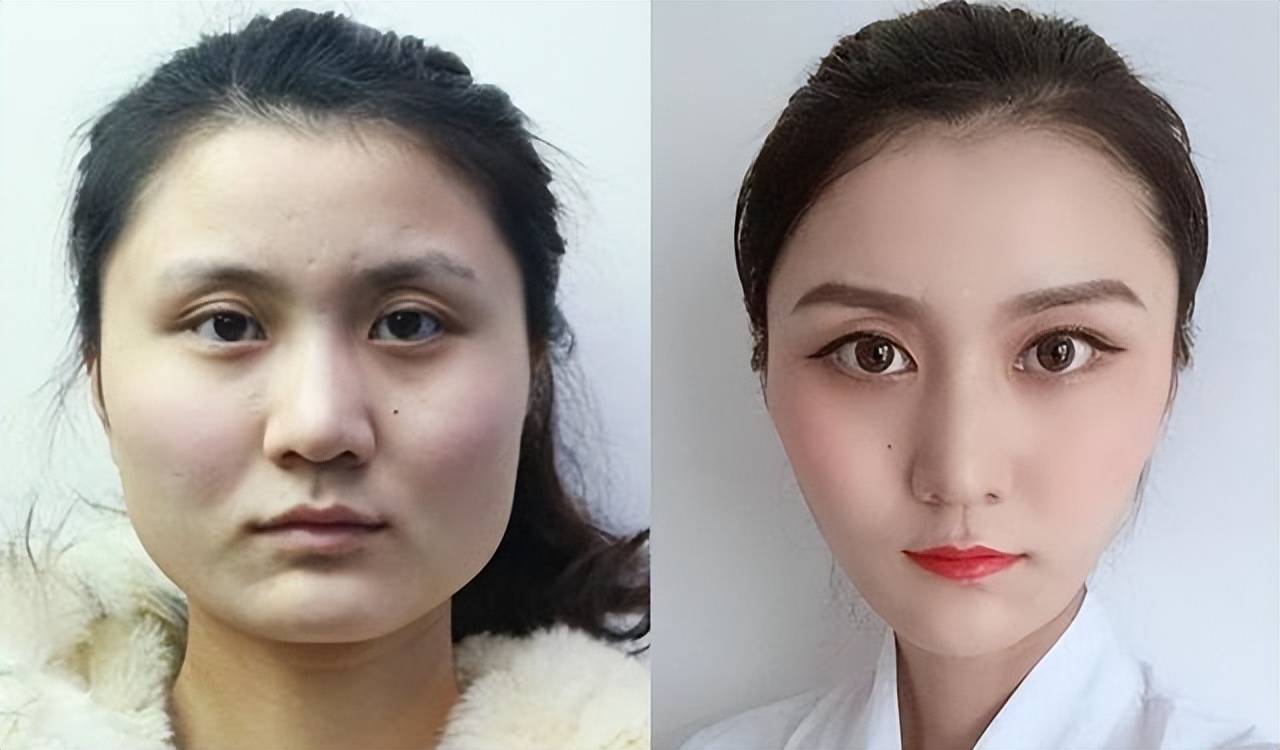 很多人问我,做 削骨手术疼不疼?