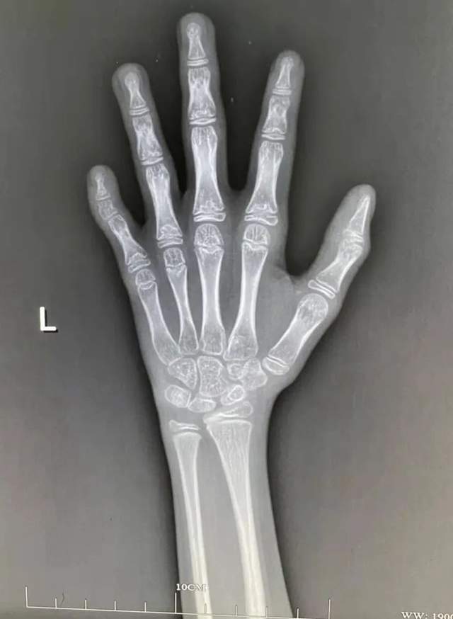 孩子需要测骨龄吗骨龄偏小就长得高