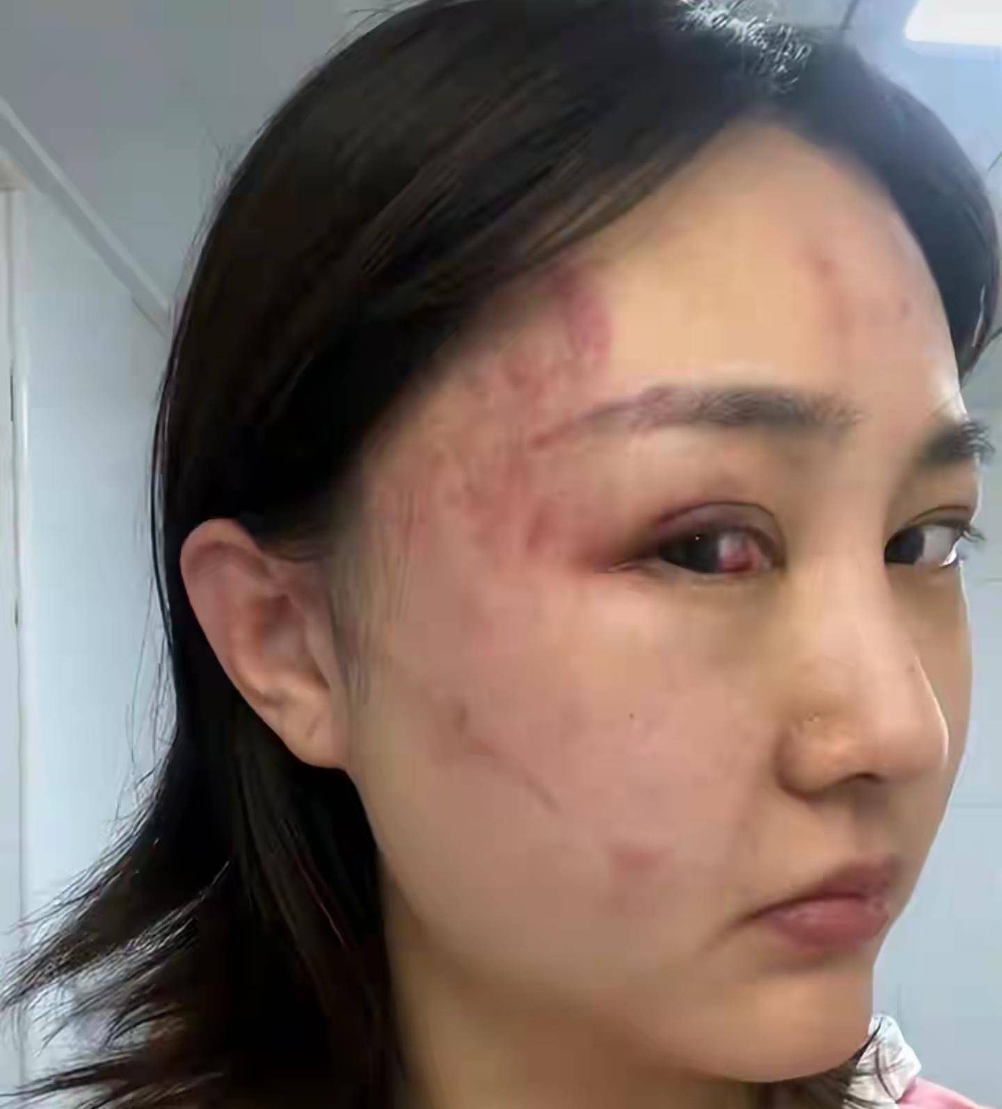 被家暴的5位女明星,一个比一个惨,眼睛出血,脑震荡,流产