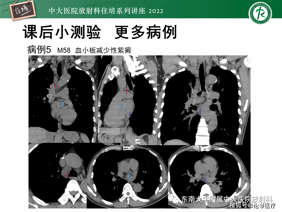 放射科住培讲座心包隐窝的ct解剖及在肿瘤影像检查中的临床意义
