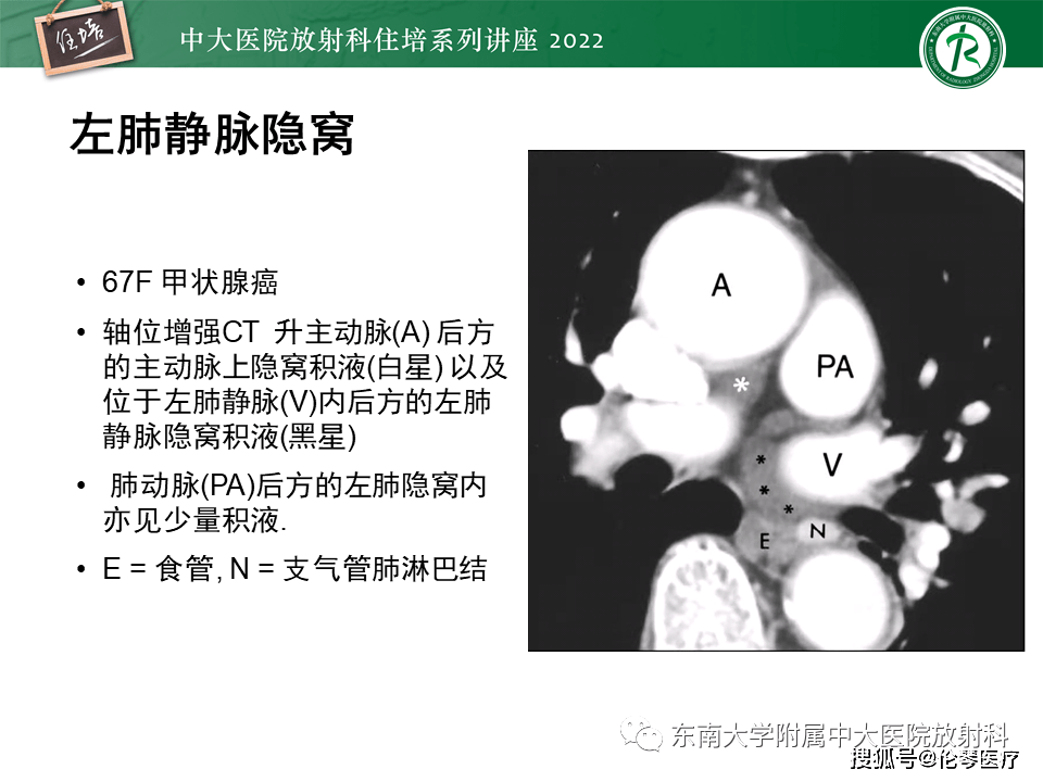 放射科住培讲座心包隐窝的ct解剖及在肿瘤影像检查中的临床意义