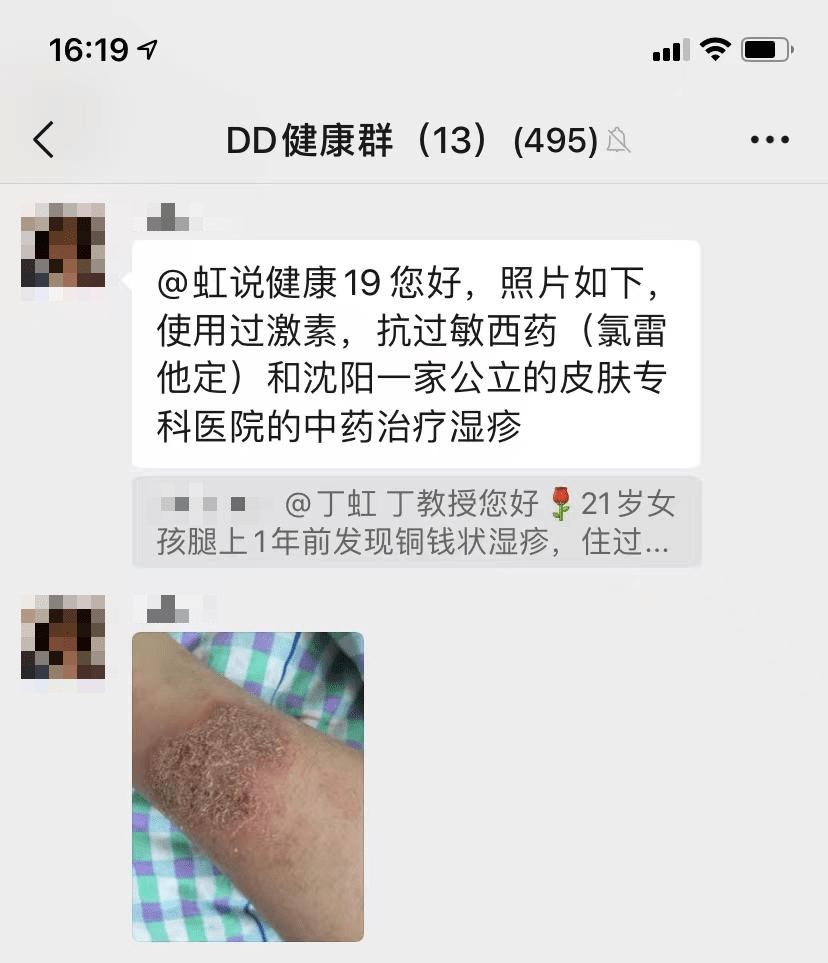 箹诗工坊:21岁女孩腿上有铜钱状湿疹,住过院,现在常抹激素