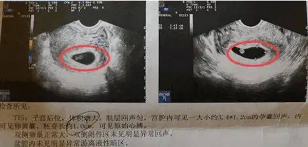 怀孕40天胸胀看男女图片